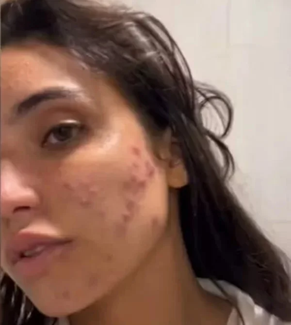 Vanessa Lopes diz que ficou com medo de perder contratos por ter acne
