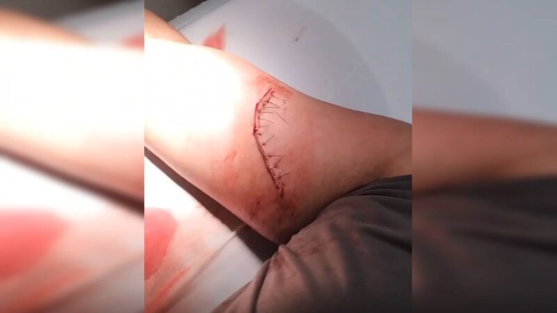Homem tem braço cortado com faca de 30 cm em briga de rua no DF