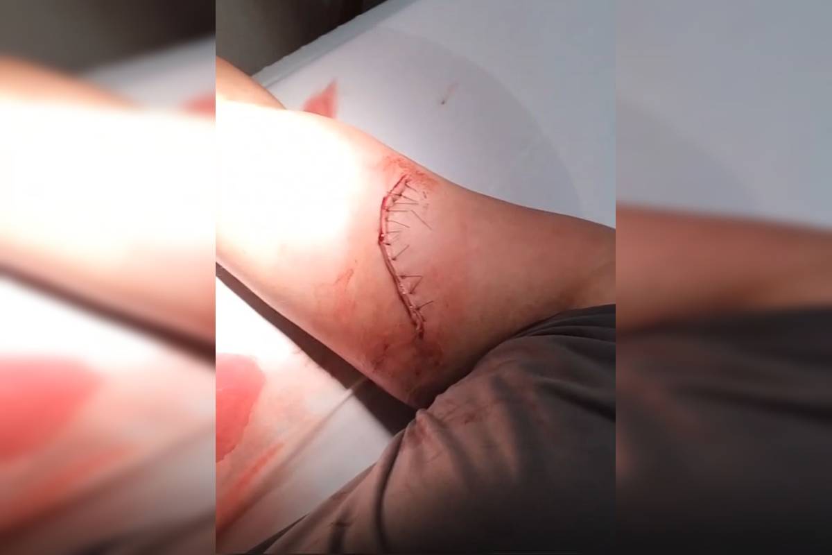 Homem tem braço cortado com faca de 30 cm em briga de rua no DF
