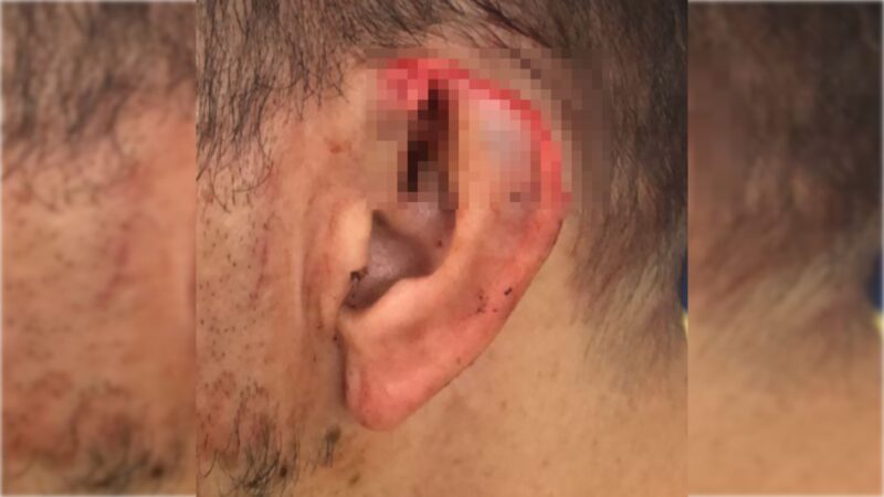 Mike Tyson do Cerrado: homem arranca parte da orelha de namorado no DF