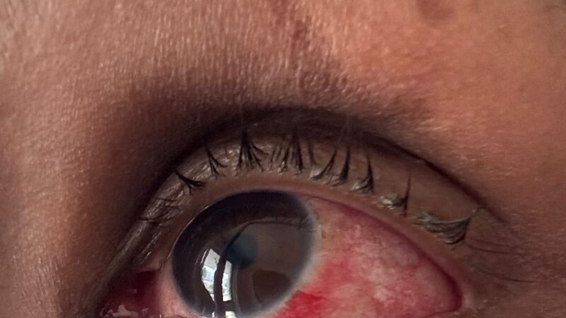 Especialistas da rede pública do Distrito Federal destacam a importância de atenção aos cuidados com a conjuntivite.