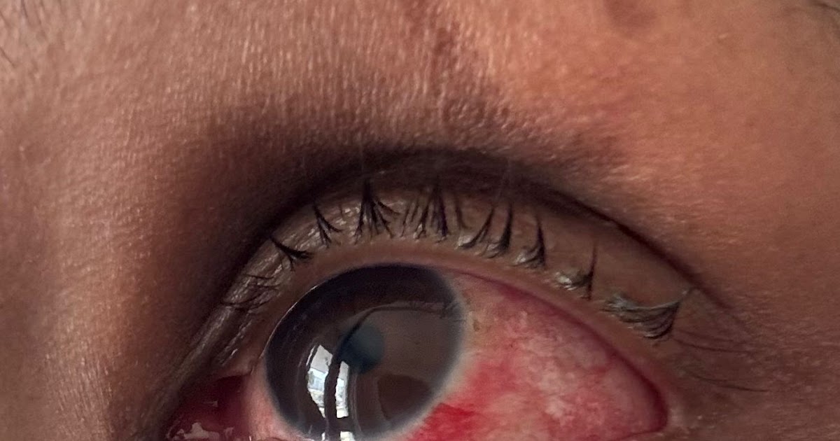 Especialistas da rede pública do Distrito Federal destacam a importância de atenção aos cuidados com a conjuntivite.