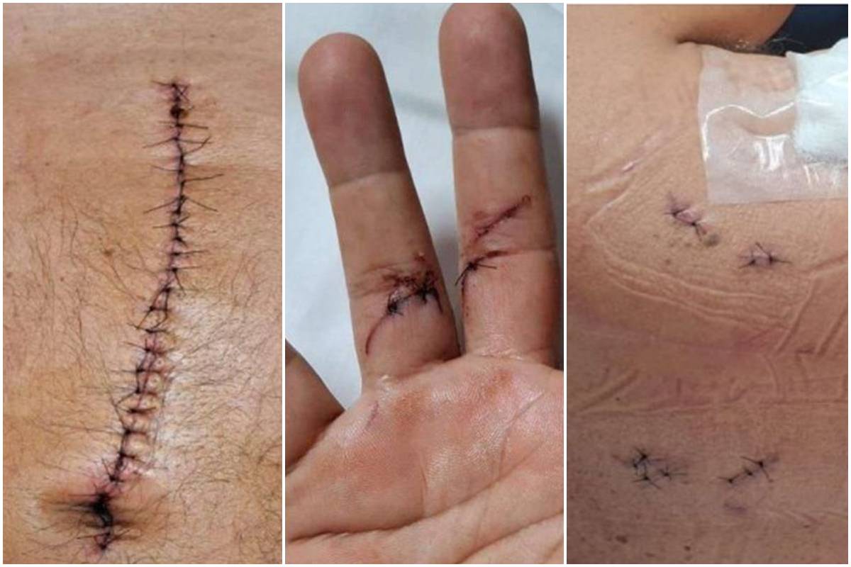 Veja lesões de major esfaqueado em trânsito por sargento que foi solto