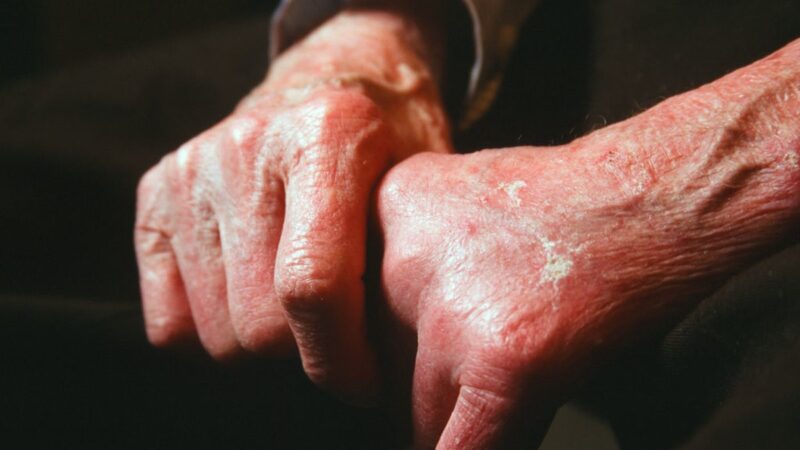 STF dá 5 anos para filhos de vítimas de hanseníase pedirem indenização