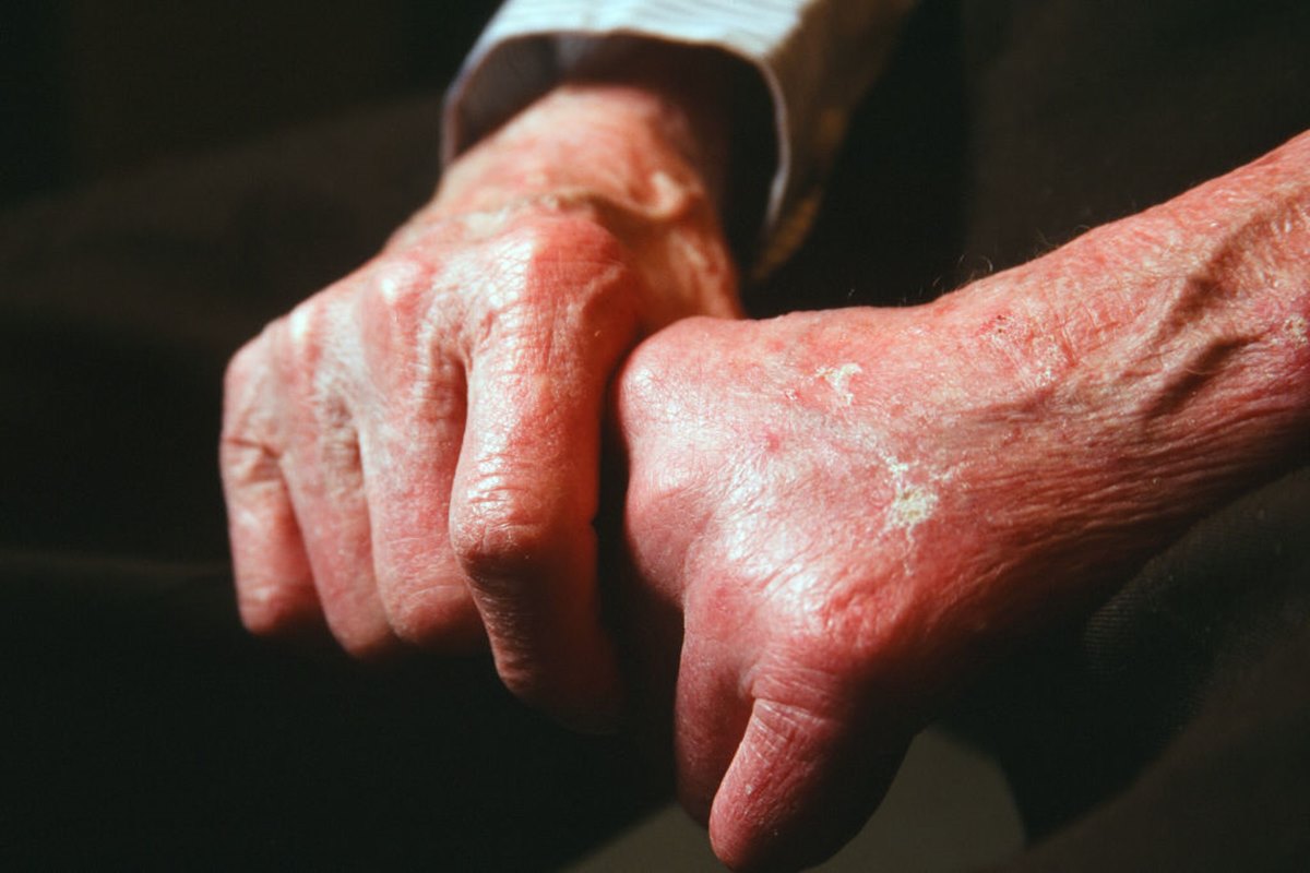 STF dá 5 anos para filhos de vítimas de hanseníase pedirem indenização