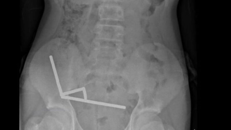Adolescente engole mais de 80 ímãs e perde parte do intestino