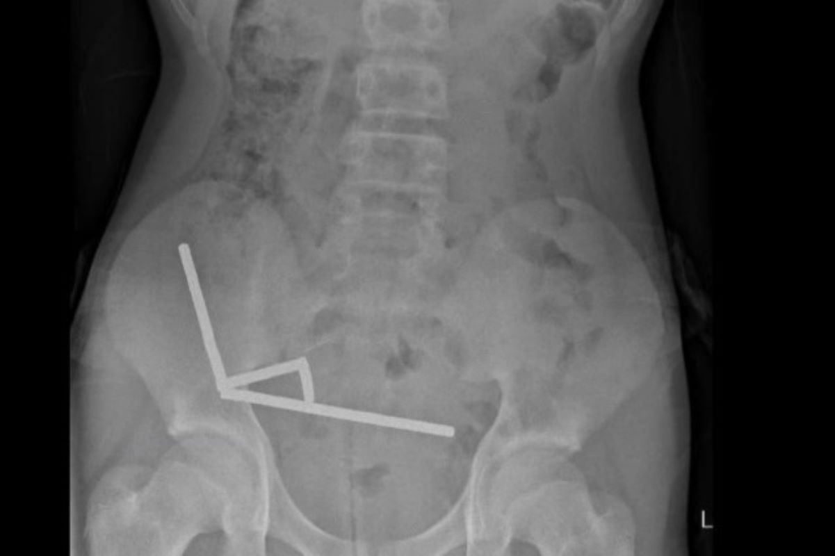 Adolescente engole mais de 80 ímãs e perde parte do intestino
