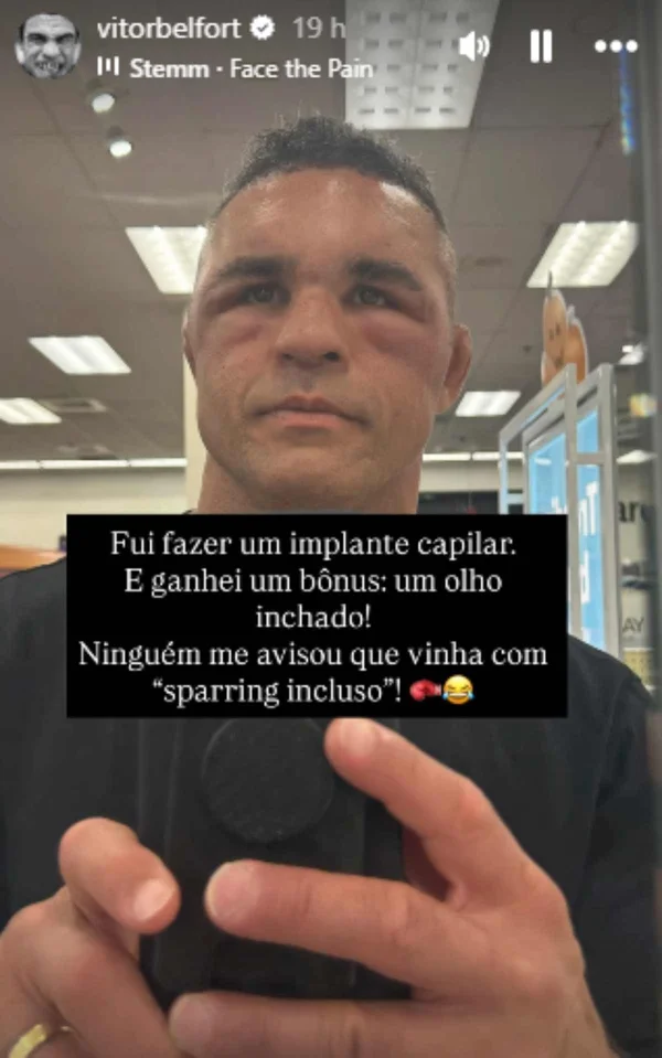 Vitor Belfort deixa web chocada após realizar implante capilar; veja